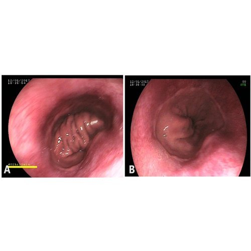 Management of hiatal hernia at the National Hospital of Niamey.
