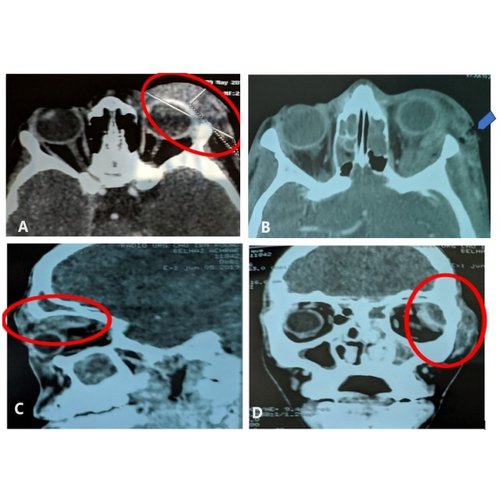 Caractéristiques épidémiologiques, thérapeutiques et évolutives de la cellulite orbitaire au Centre Hospitalier Régional de Maradi, Niger.