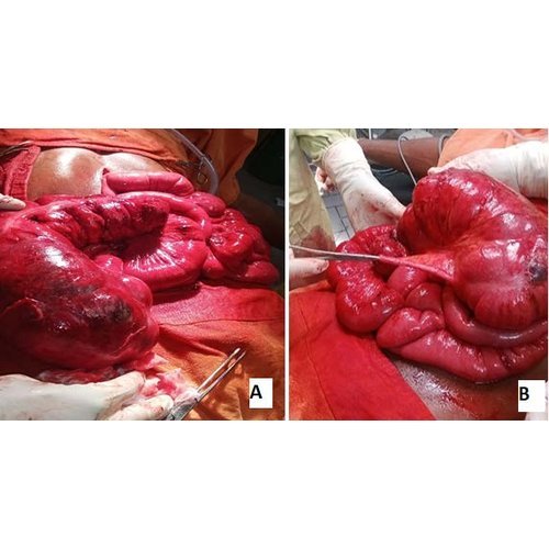 Volvulus of the cecum: A case report and review of the literature.