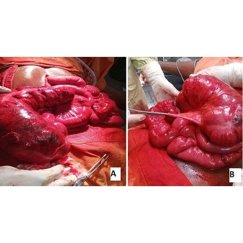 Volvulus du cæcum : à propos d'un cas et revue de la littérature.