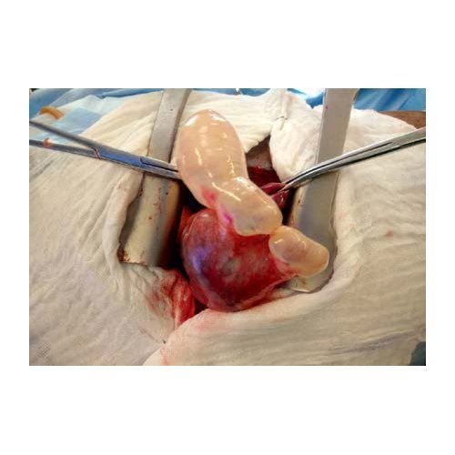 Epidemiological and evolutive aspects of spontaneous pneumothorax at Amirou Boubacar Diallo National Hospital, Niamey.