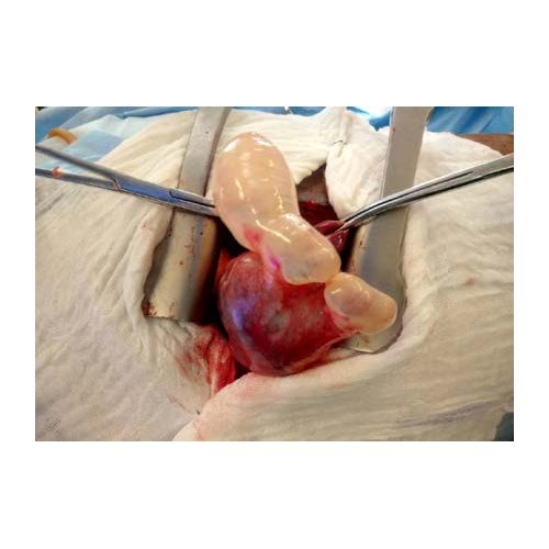 Aspects épidémiologiques et évolutifs du pneumothorax spontané à l'Hôpital National Amirou Boubacar Diallo de Niamey.