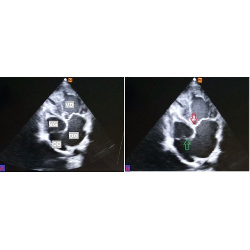 Congenitally Corrected Transposition of Great Arteries: about one case in adult and literature review.