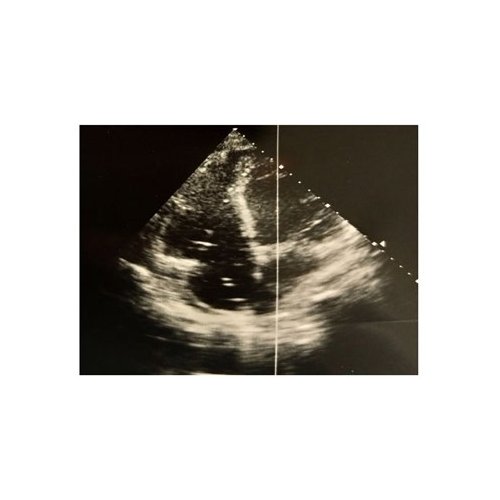 Endocardite aortique à Enterococcus faecalis compliquée d’une polyarthrite septique : à propos d’un cas.