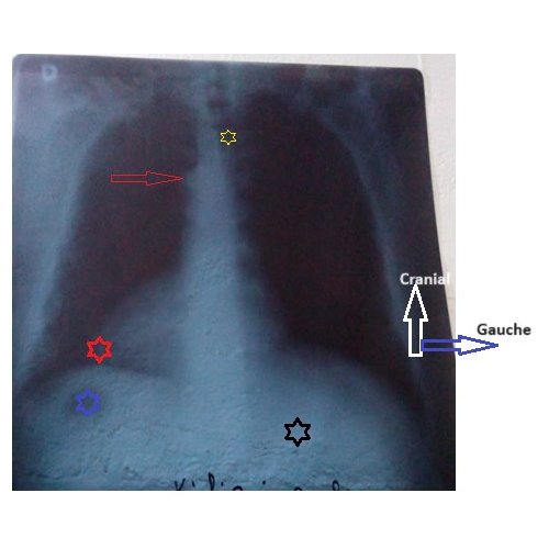 Intérêt de l’électrocardiogramme dans le diagnostic de Situs inversus totalis en milieu rural : À propos d’un cas et revue de la littérature.