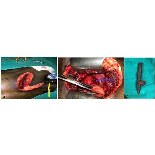 Management of severe thoracic trauma at Niamey General Referral Hospital.