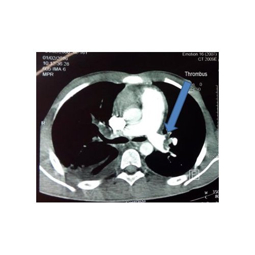 Syndrome anti-phospholipide primaire révélé par une ischémie de l’artère mésentérique supérieure et une maladie thromboembolique veineuse : à propos d’une observation au Burkina Faso.