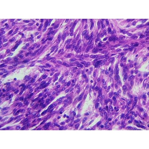 Carcinome tubulo-mucineux à cellules fusiformes de bas grade du rein : à propos d’une observation.