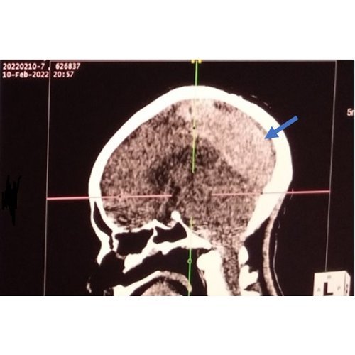 Thromboembolism and major bleeding in patients with mechanical valve prosthesis at the Cardiac of Shisong, Cameroon: about six cases.