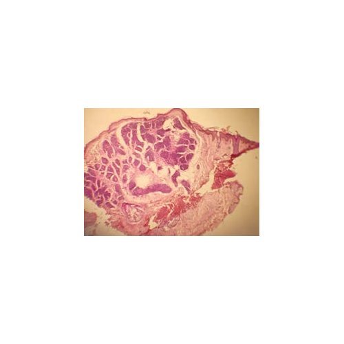 Multiple familial trichoepithelioma: a case report at Zinder National Hospital. 866B