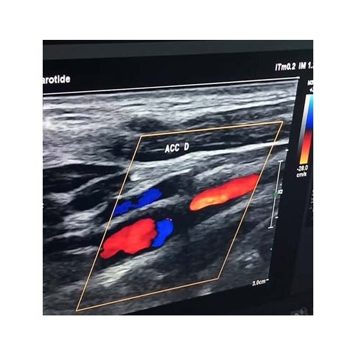 Dissection de l’aorte thoracique descendante révélatrice de la maladie de Takayasu : à propos d’un cas à l’Institut de cardiologie d’Abidjan.