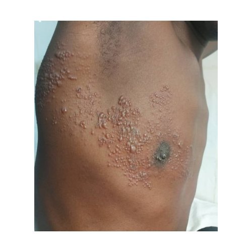 Epidemiological, clinical and therapeutic profile of herpes zoster in the dermatology 1162B and venereology department of the Zinder national hospital.