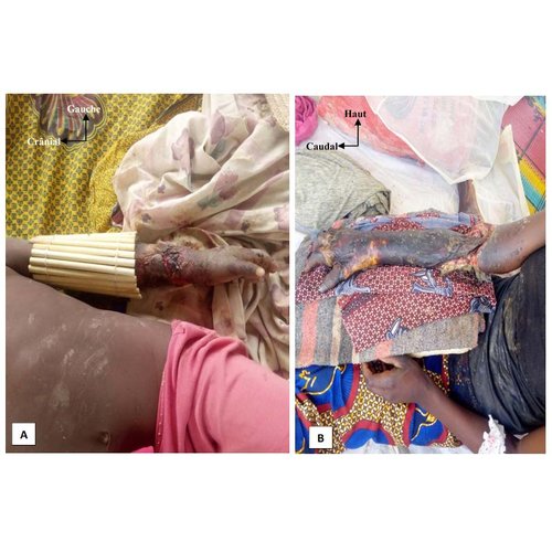 Gangrène des membres associée au traitement traditionnel des traumatismes : une cause d’amputation majeure des membres dans la région de Zinder, Niger.