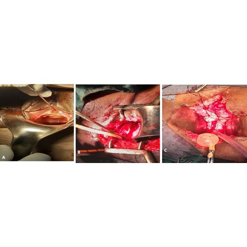 Fistules uro-génitales féminines iatrogènes : étude multicentrique de 60 cas colligés au niveau de 3 centres de référence au Niger.