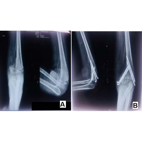 Traitement chirurgical des fractures supra-condyliennes chez l’enfant à l’Hôpital National de Zinder, Niger.