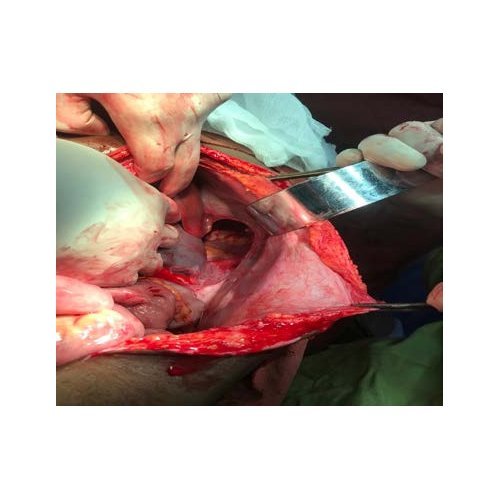 Post-traumatic diaphragmatic rupture: two observations at the National Hospital of 1850B Niamey.