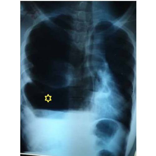 Tuberculose multifocale orbitaire et pleurale : à propos d’un cas et revue de la littérature.
