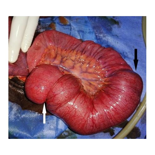 Invaginations intestinales de l'adulte à l'Hôpital National de Zinder.