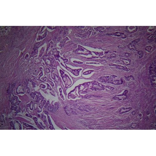 Les cancers colorectaux examinés au laboratoire d’anatomie pathologique de la Faculté des Sciences de la Santé de l’Université Abdou Moumouni de Niamey : aspects épidémiologiques et anatomopathologiques.