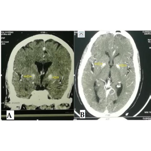 Manifestations parkinsoniennes révélant un syndrome de Fahr : à propos d'un cas.