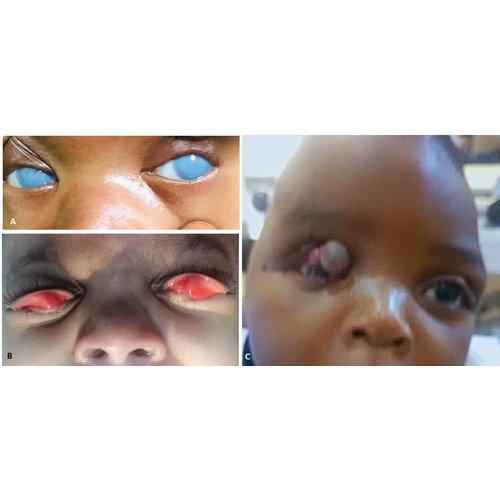 Aspects épidémiologiques et cliniques des malformations oculaires à Niamey