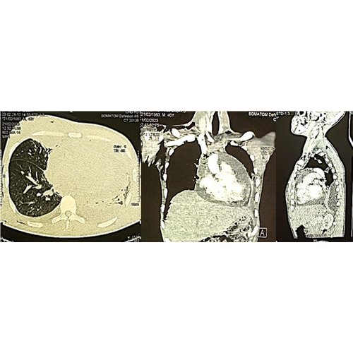 Cellulite cervico-faciale aiguë diffuse d'origine dentaire compliquée d'un pyothorax, d'une péricardite et d'une médiastinite : un cas inédit