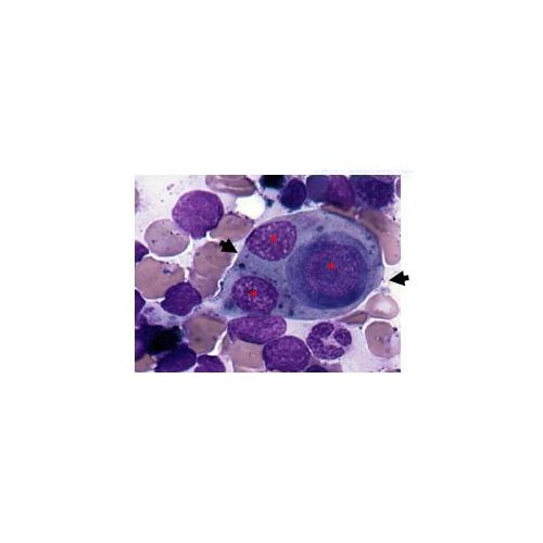 Contribution of Cyto-Anatomopathology to the Diagnosis of Nodal Rosai- Dorfman Disease at Zinder National Hospital: A Case Report.