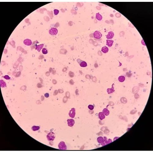 Chylous collection in serous membrane revealing a non-Hodgkin’s 1025B lymphoma: a case report at Hôpital National Amirou Boubacar Diallo, Niamey.