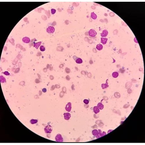 Épanchement chyleux des séreuses révélant un lymphome non hodgkinien : à propos d'un cas observé à l'Hôpital National Amirou Boubacar Diallo, Niamey
