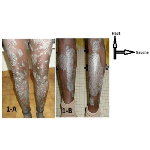 Epidemiological and clinical pattern of psoriasis in the Dermatology and Venereology Department of National Hospital of Niamey: A study of 54 cases.