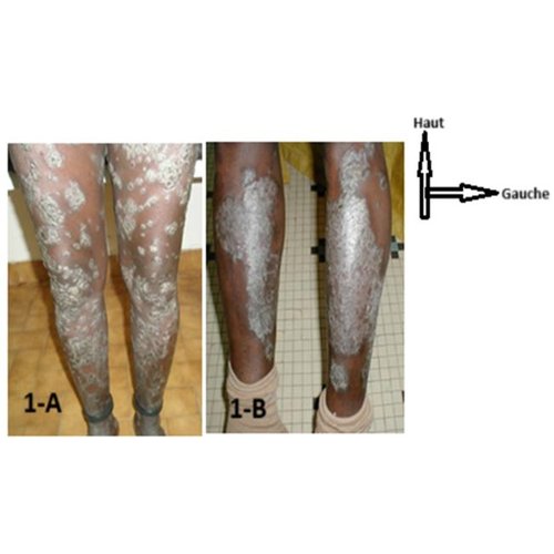 Aspects épidémiologiques et cliniques du psoriasis au service de Dermatologie-Vénéréologie de l'Hôpital National de Niamey : à propos de 54 cas