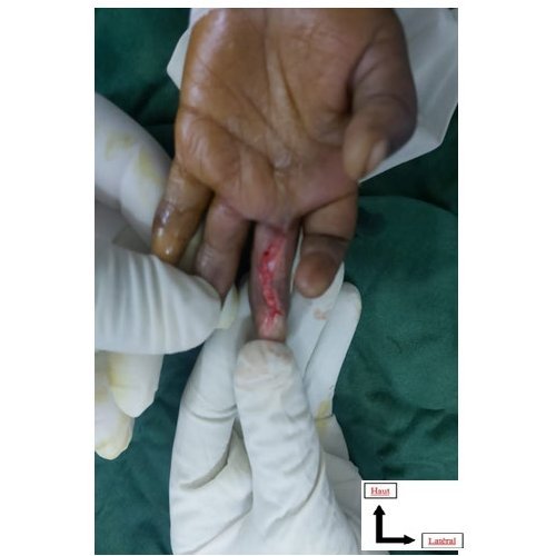 Surgical treatment of hand flanges in children at the National Hospital Amirou Boubacar Diallo (HNABD) in Niamey (Niger): about 16 cases.