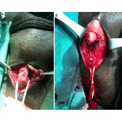 Management of Urethral Strictures at the National Hospital of Zinder.