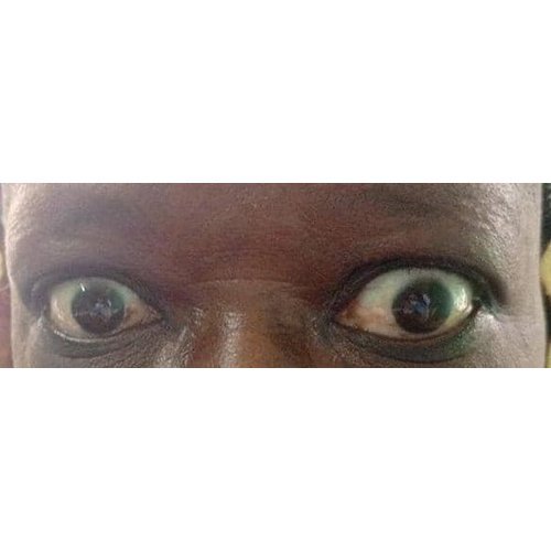 Predictive factors of relapses after medical treatment of Graves’ disease in Ivory Coast.
