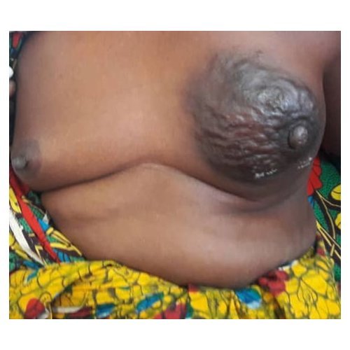 The contribution of cytology to breast diseases at Niamey National hospital, Niger.