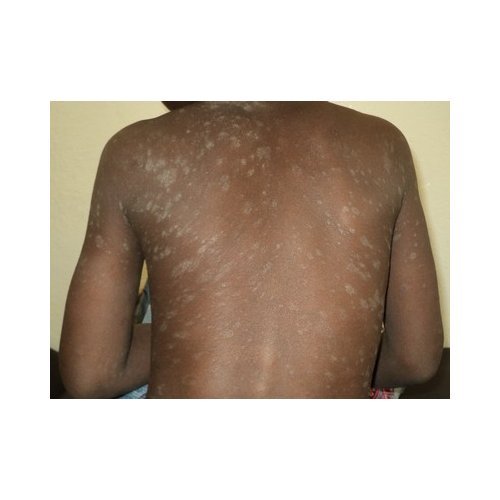 Clinical Features and Management of Pityriasis Rosea in Black Skin: Experience at the National Hospital of Niamey (Niger).