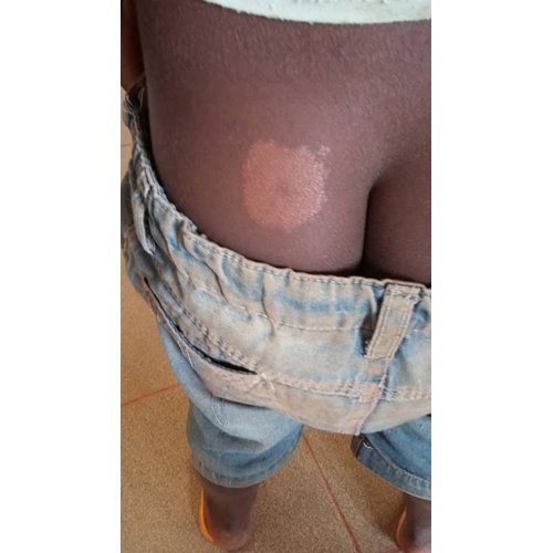 Aspects épidémiologiques et diagnostiques de la lèpre chez l'enfant congolais