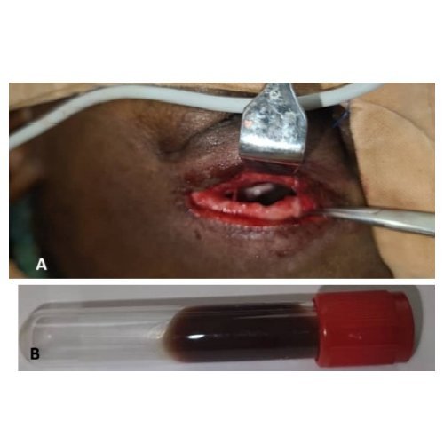 Fronto-ethmoidal mucocele with orbital extension, about a case at the Maradi Reference Hospital.