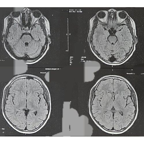 Autoimmune rhombencephalitis in a child at the Amirou Boubacar Diallo National Hospital of Niamey (NIGER).