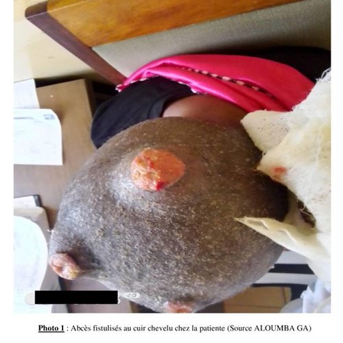 Actinomycétome à grains rouge du cuir chevelu : à propos d'un cas au CHU de Brazzaville