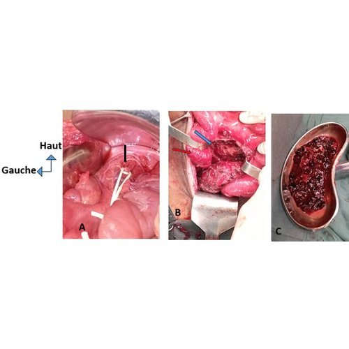 A ruptured superior mesenteric artery aneurysm: a case report.