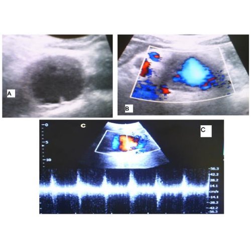 Innominate artery aneurysm: case report and review of the literature.