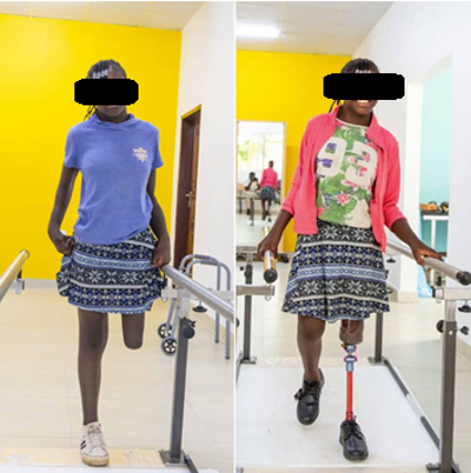Amputations majeures de membre et ses conséquences : analyse d'une cohorte de 64 patients