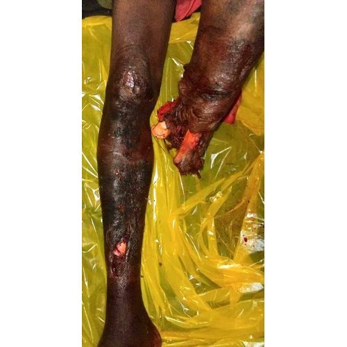 Major Traumatic Limb Amputations: Epidemiological and Clinical Aspects and Patient Outcomes