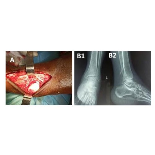 Outcomes of the management of pure medial subtalar dislocation: a one- year follow-up case report.