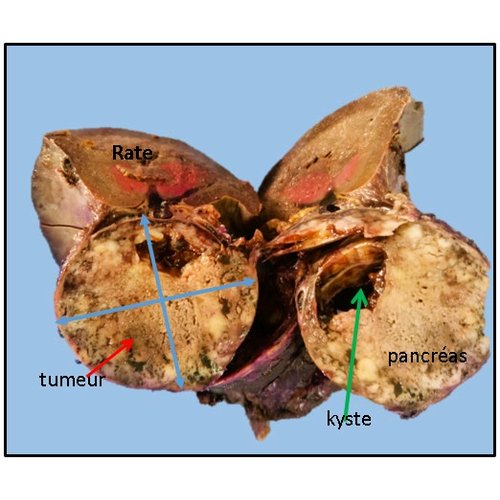 Lésions kystiques du pancréas : corrélation anatomo-radiologique. À propos de 9 cas
