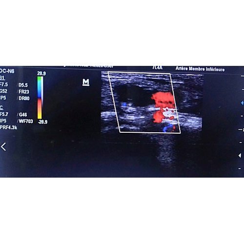 Peripartum cardiomyopathy complicated by acute ischemia of the right lower limb due to thrombus: a case report