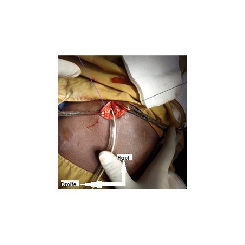 Pyogenic-liver abscess: about 2 cases at Zinder national hospital and literature review.