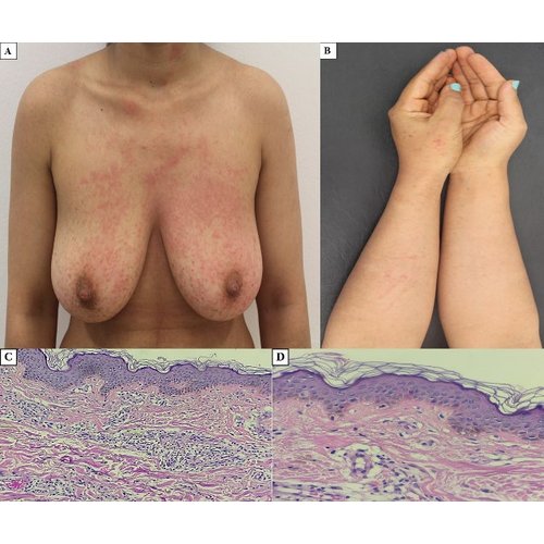 Mastocytose systémique à manifestations cutanées télangiectasiques : à propos d’un cas
