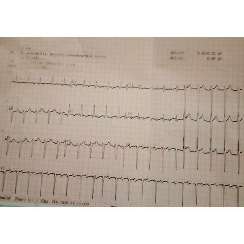 Canal atrioventriculaire partiel découvert à l'âge adulte : à propos d'un cas à l'Hôpital national de Zinder, Niger.